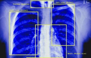 This image shows a blue xray image of a person's chest - it shows the ribs, the faint outline of a heart, and other organs. The image features yellow squares surrounding the organs (left lung, trachea, right lung, heart, diaphragm) - each of them feature labels such as: normal, midline, normal size. There is text in the right bottom corner in white which states 'no abnormalities detected'.